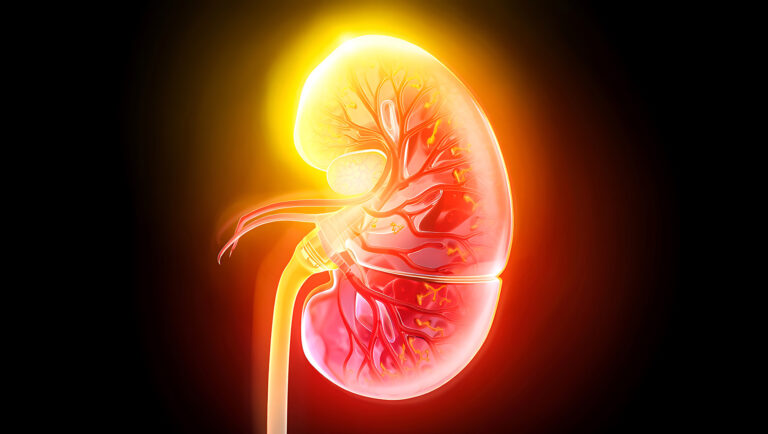 Nierensteine in der Niere – Darstellung von Kristallablagerungen im Harnsystem bei Männern